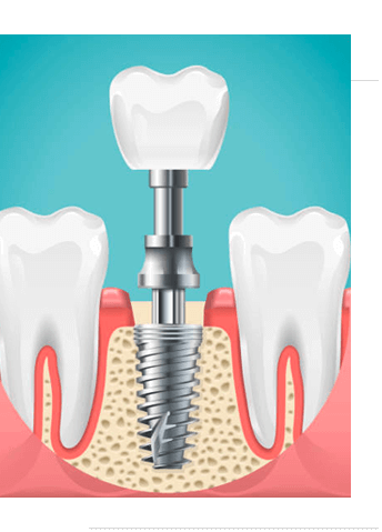 Dental surgery. Tooth implant cut vector illustration. Healthy teeth and dental implant, stomatology poster. Implant dental metal screw in gum