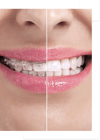 Teeth with braces before and after