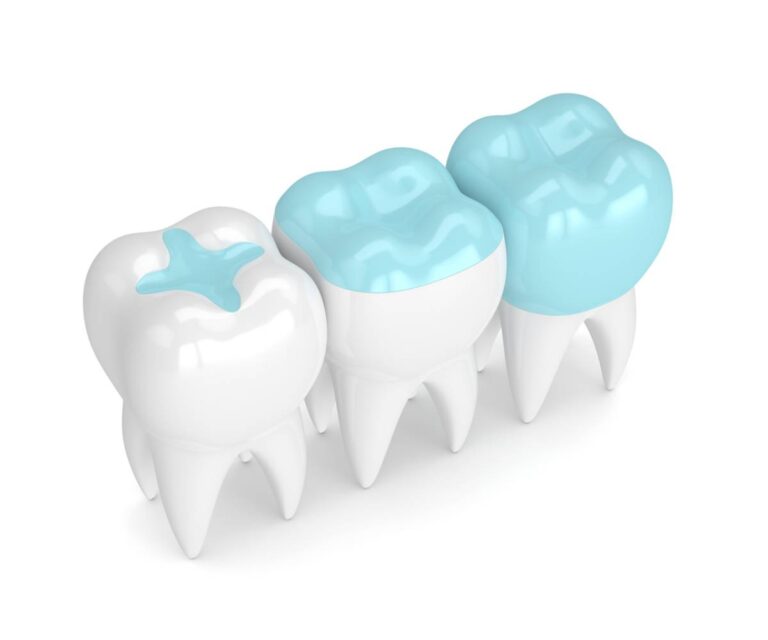 featured image for are composite fillings more durable