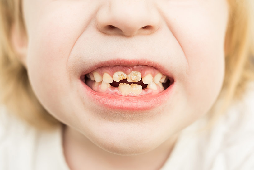 Baby bottle tooth decay