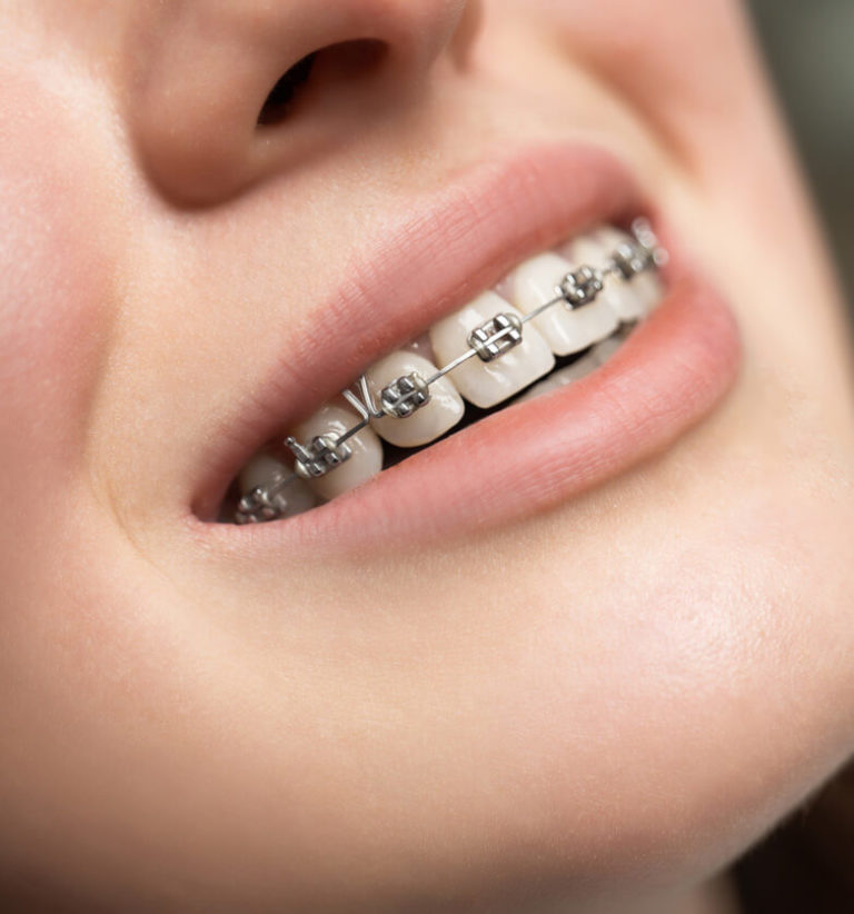 Braces in North Hollywood Victory Plaza Dental Group