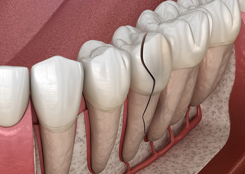 Can a Broken Root Canal Tooth Be Repaired: The Ultimate Guide