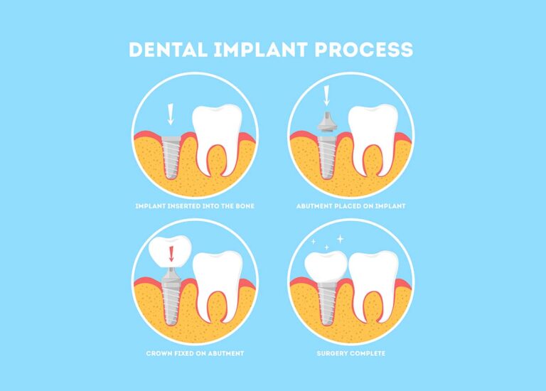 Dental Implants Process