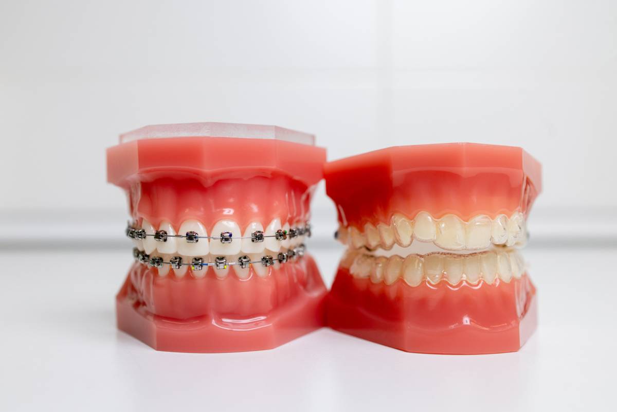 featured image: how to choose braces or Invisalign