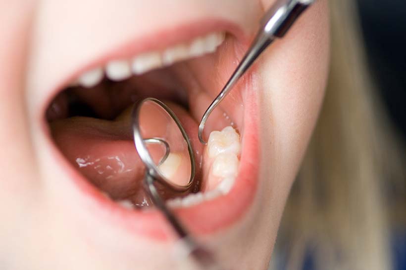 children primary molar
