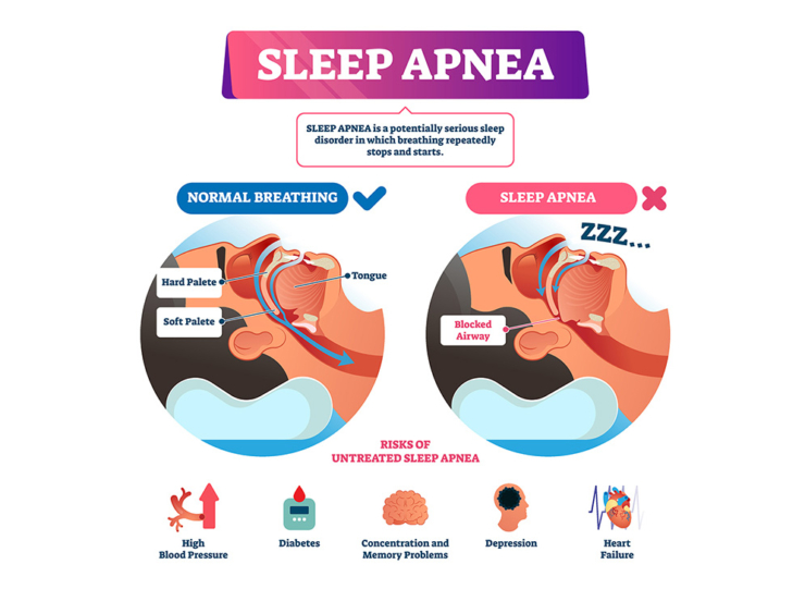 Sleep Apnea treatment