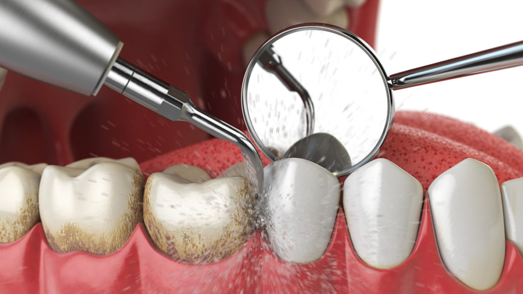 Cost of Dental Cleaning in Los Angeles, CA
