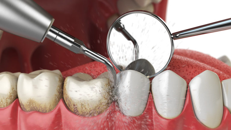 Teeth cleaning cost North Hollywood