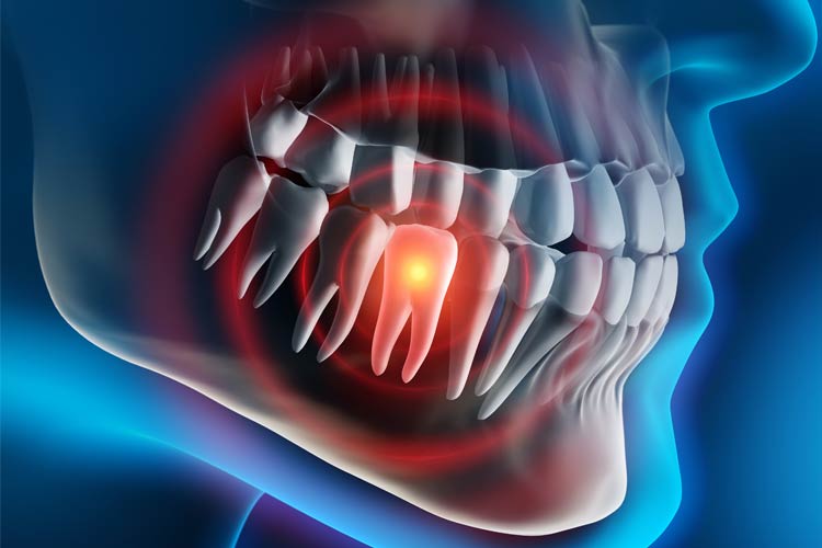 tooth extraction Cost North Hollywood