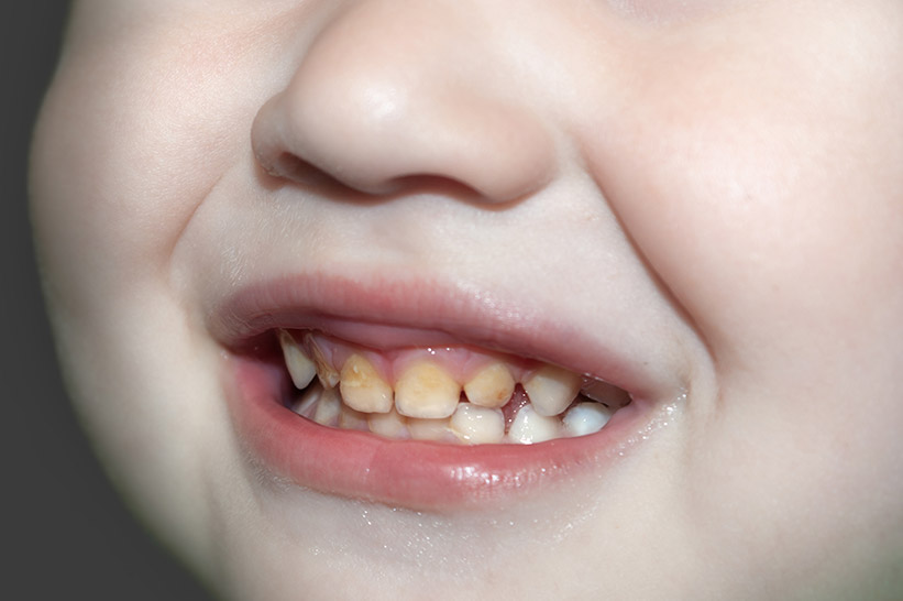 yellow teeth in children